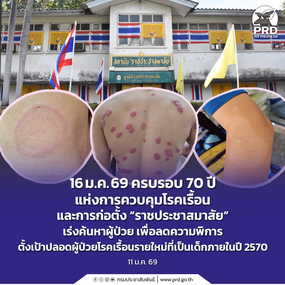 16 ม.ค. 69 ครบรอบ 70 ปี แห่งการควบคุมโรคเรื้อนและการก่อตั้ง &ldquo;ราชประชาสมาสัย&rdquo; เร่งค้นหาผู้ป่วย เพื่อลดความพิการ ตั้งเป้าปลอดผู้ป่วยโรคเรื้อนรายใหม่ที่เป็นเด็กภายในปี 2570